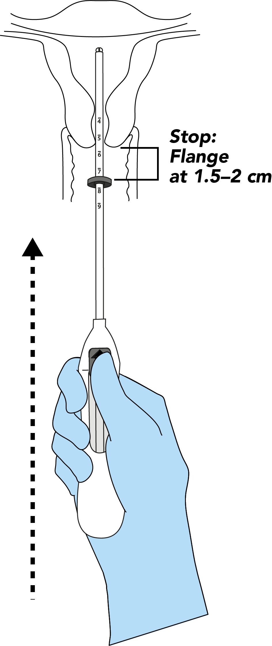 Introduce the placement tube